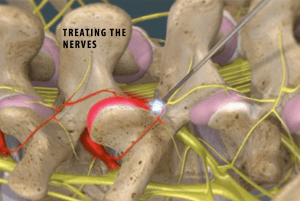 Lower Back Pain Relieving Procedure-Minimally Invasive