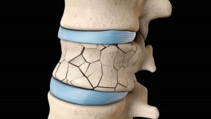 Disc Herniation and Treatments