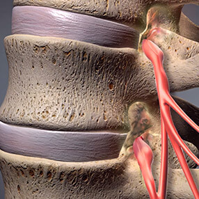 Spinal Stenosis and Low Back Pain - Atlanta Brain and Spine Care